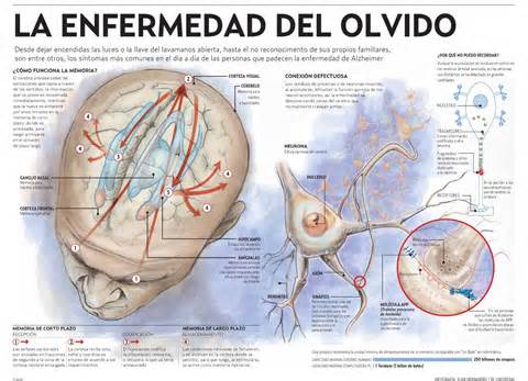 Pronunciation alzheimer How to